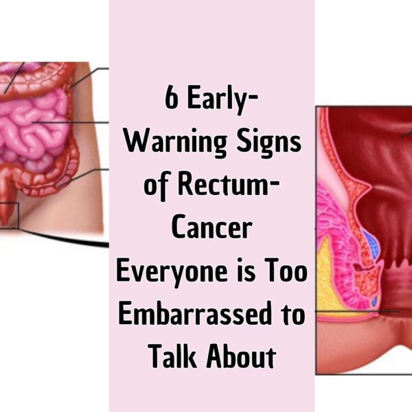 6 Early-Warning Signs of Rectum-Cancer Everyone is Too Embarrassed to Talk About