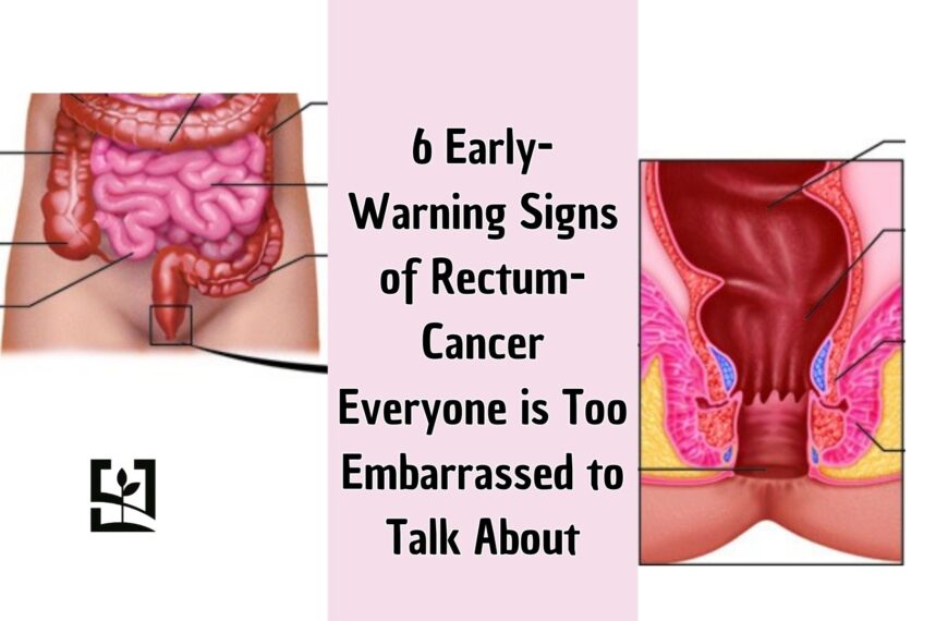 6 Early-Warning Signs of Rectum-Cancer Everyone is Too Embarrassed to Talk About