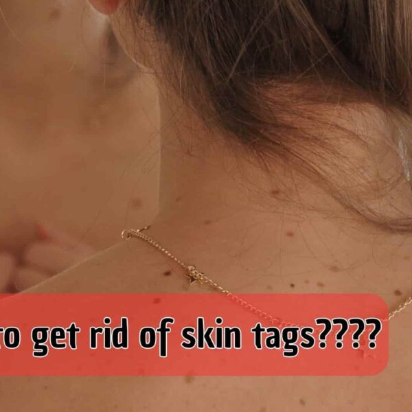 How to get rid of skin tags???