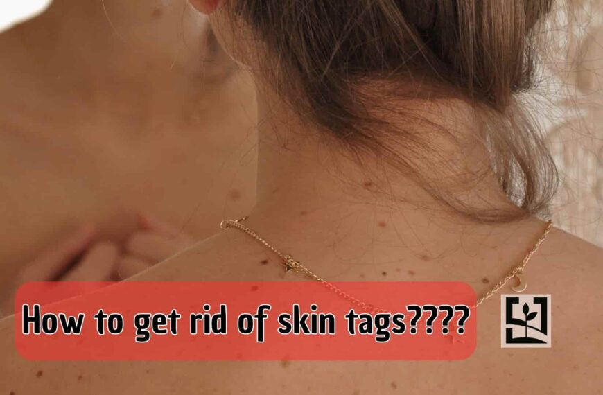 How to get rid of skin tags???