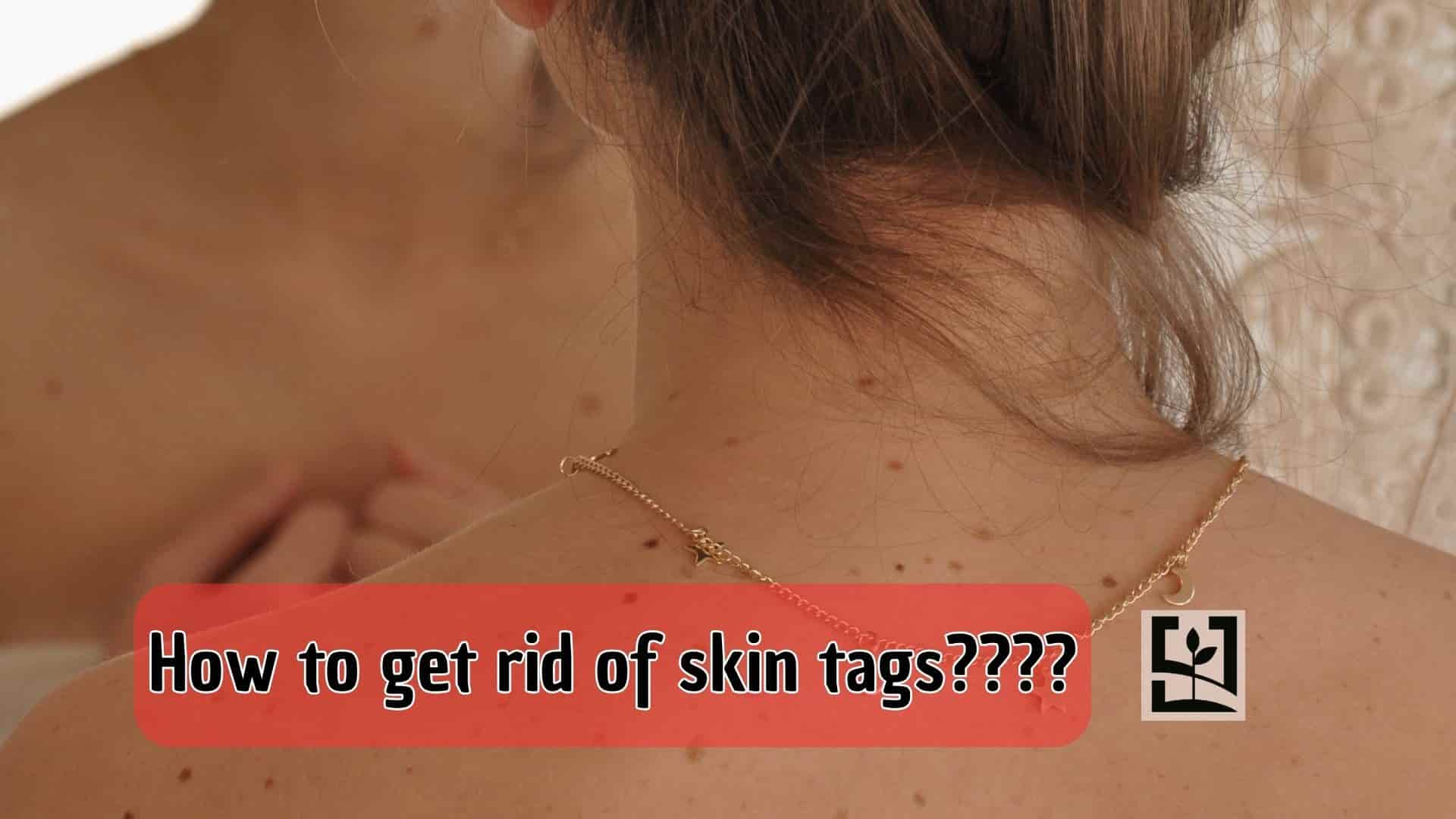 How to get rid of skin tags???