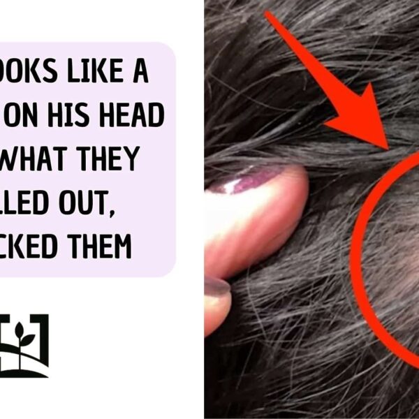 ITS LOOKS LIKE A PIMPLE ON HIS HEAD BUT WHAT THEY PULLED OUT, SHOCKED THEM