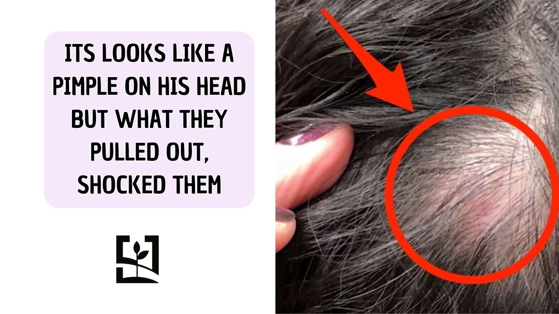 ITS LOOKS LIKE A PIMPLE ON HIS HEAD BUT WHAT THEY PULLED OUT, SHOCKED THEM