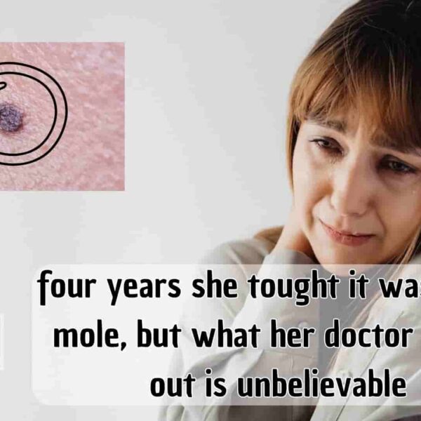 four years she tought it was just a mole, but what her doctor yanks out is unbelievable