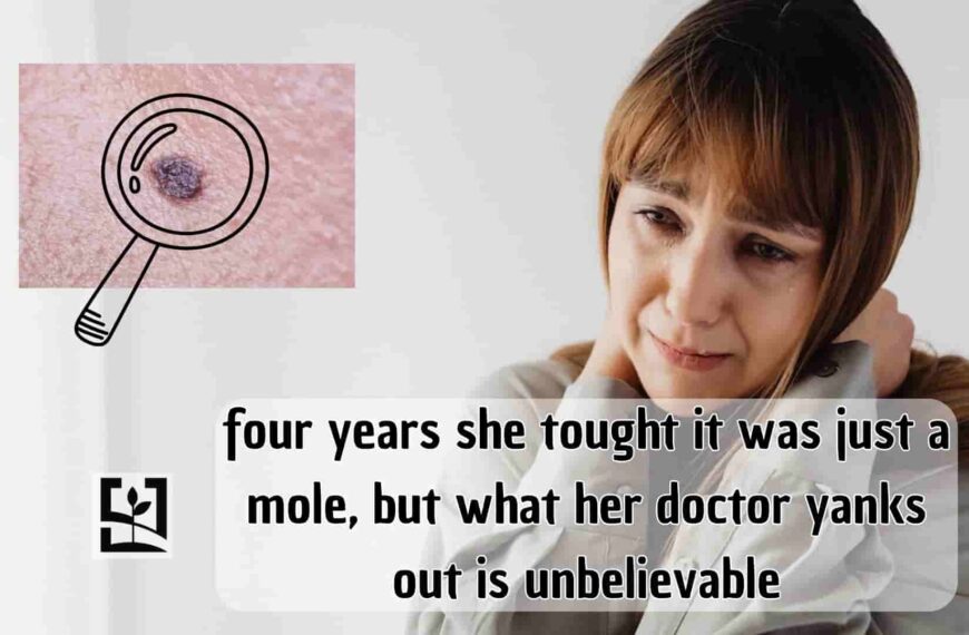 four years she tought it was just a mole, but what her doctor yanks out is unbelievable