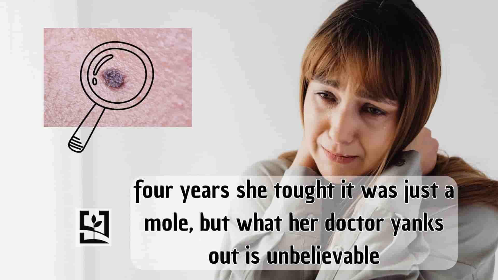 four years she tought it was just a mole, but what her doctor yanks out is unbelievable